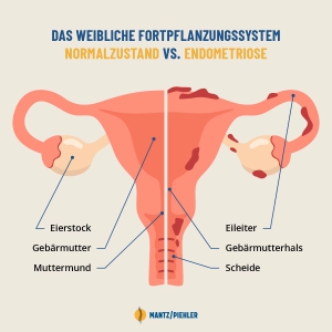 Osteopathie bei Endometriose